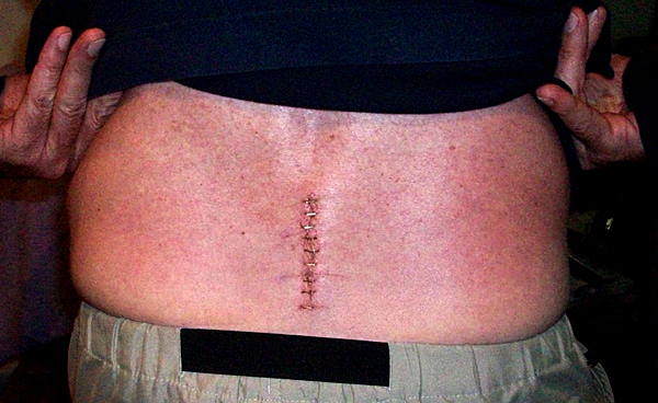 No, the staples don't hurt. Pushin' in the sides of my belly for the photo hurts.